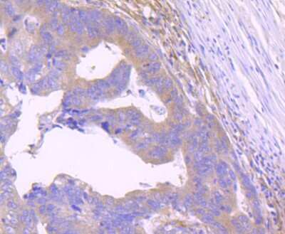 Immunohistochemistry-Paraffin: STAT2 Antibody (JF0884) [NBP2-67168] - Analysis of paraffin-embedded human colon cancer tissue using anti-STAT2 antibody. Counter stained with hematoxylin.