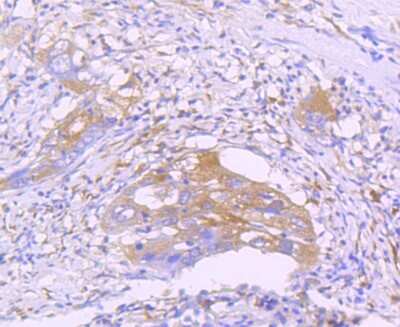 Immunohistochemistry-Paraffin: STAT2 Antibody (JF0884) [NBP2-67168] - Analysis of paraffin-embedded human lung cancer tissue using anti-STAT2 antibody. Counter stained with hematoxylin.