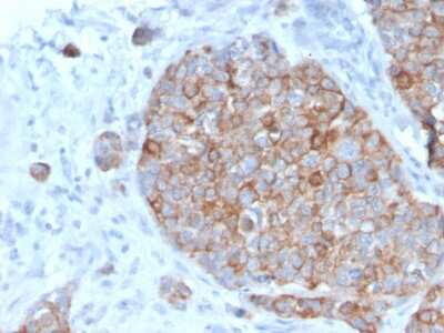 Immunohistochemistry-Paraffin: STAT2 Antibody (STAT2/2650) - Azide and BSA Free [NBP3-08587] - Formalin-fixed, paraffin-embedded human Prostate Carcinoma stained with STAT2 Mouse Monoclonal Antibody (STAT2/2650).