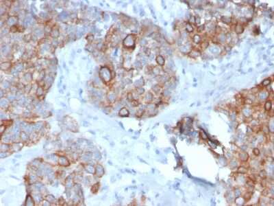 Immunohistochemistry-Paraffin: STAT2 Antibody (STAT2/2650) - Azide and BSA Free [NBP3-08587] - Formalin-fixed, paraffin-embedded human Prostate Carcinoma stained with STAT2 Mouse Monoclonal Antibody (STAT2/2650).