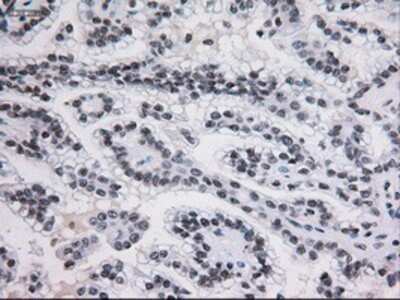 Immunohistochemistry: STAT3 Antibody (OTI21E7) - Azide and BSA Free [NBP2-74378] - Staining of paraffin-embedded Carcinoma of kidney using anti-STAT3 mouse monoclonal antibody.