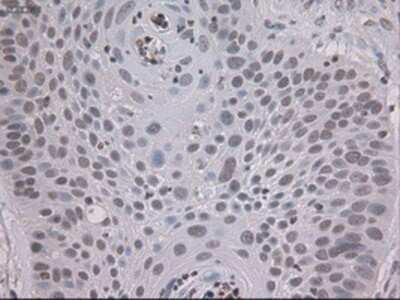 Immunohistochemistry: STAT3 Antibody (OTI21E7) - Azide and BSA Free [NBP2-74378] - Staining of paraffin-embedded Carcinoma of lung using anti-STAT3 mouse monoclonal antibody.