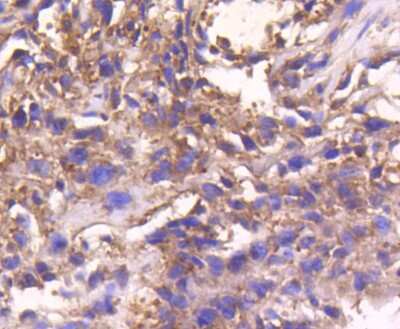 Immunohistochemistry-Paraffin: STAT3 Antibody (SY34-01) [NBP2-67392] - Analysis of paraffin-embedded human breast carcinoma tissue using anti-STAT3 antibody. Counter stained with hematoxylin.