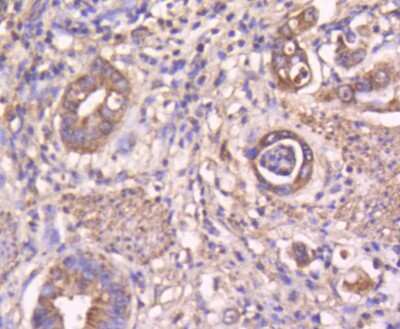 Immunohistochemistry-Paraffin: STAT3 Antibody (SY34-01) [NBP2-67392] - Analysis of paraffin-embedded human gastric carcinoma tissue using anti-STAT3 antibody. Counter stained with hematoxylin.