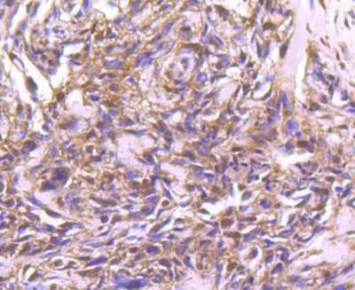 Immunohistochemistry-Paraffin: STAT4 Antibody (JJ08-85) [NBP2-67868] - Analysis of paraffin-embedded human breast carcinoma tissue using anti-STAT4 antibody. Counter stained with hematoxylin.