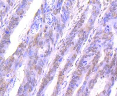 Immunohistochemistry-Paraffin: STAT4 Antibody (JJ08-85) [NBP2-67868] - Analysis of paraffin-embedded human colon cancer tissue using anti-STAT4 antibody. Counter stained with hematoxylin.