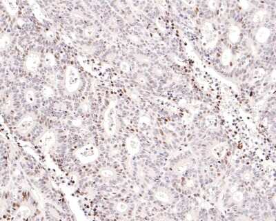 Immunohistochemistry-Paraffin: STAT4 Antibody (JJ08-85) [NBP2-67868] - Analysis of paraffin-embedded human colon carcinoma tissue with Rabbit anti-STAT4 antibody washed with ddH2O and PBS, and then probed with the primary antibody  at 1/400 dilution for 1 hour at room temperature. The detection was performed using an HRP conjugated compact polymer system. DAB was used as the chromogen. Tissues were counterstained with hematoxylin and mounted with DPX.