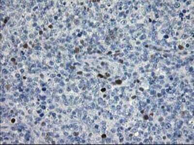 Immunohistochemistry: STAT4 Antibody (OTI2F3) - Azide and BSA Free [NBP2-74389] - Staining of paraffin-embedded Human lymphoma tissue using anti-STAT4 mouse monoclonal antibody.