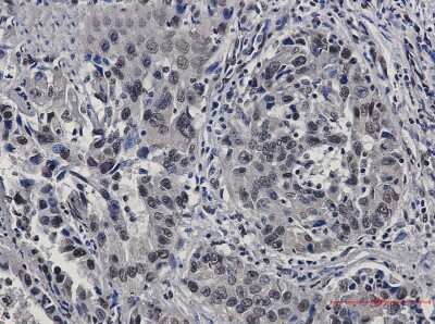 Immunohistochemistry-Paraffin: STAT4 Antibody (S02-1C1) [NBP3-14977] - Immunohistochemistry of STAT4 in paraffin-embedded Human lung cancer tissue using STAT4 Rabbit mAb at dilution 1/50