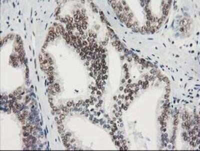 Immunohistochemistry: STAT5A Antibody (OTI9F7) - Azide and BSA Free [NBP2-74392] - Staining of paraffin-embedded Carcinoma of Human prostate tissue using anti-STAT5A mouse monoclonal antibody.