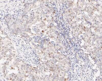 Immunohistochemistry-Paraffin: STAT5A [p Tyr694] Antibody (SC05-31) [NBP2-67590] - Immunohistochemical analysis of paraffin-embedded human breast carcinoma tissue using anti-STAT5A antibody. The section was pre-treated using heat mediated antigen retrieval with sodium citrate buffer (pH 6.0) for 20 minutes. The tissues were blocked in 5% BSA for 30 minutes at room temperature, washed with ddH2O and PBS, and then probed with the primary antibody (ET1610-48, 1/50) for 30 minutes at room temperature. The detection was performed using an HRP conjugated compact polymer system. DAB was used as the chromogen. Tissues were counterstained with hematoxylin and mounted with DPX.