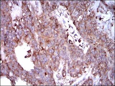 Immunohistochemistry: STAT5a Antibody (6D4) [NBP2-37441] - Immunohistochemical analysis of paraffin-embedded ovarian cancer tissues using STAT5A mouse mAb with DAB staining.