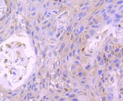 Immunohistochemistry-Paraffin: STAT5b Antibody (SD08-08) [NBP2-67795] - Analysis of paraffin-embedded human breast carcinoma tissue using anti-STAT5b antibody. Counter stained with hematoxylin.