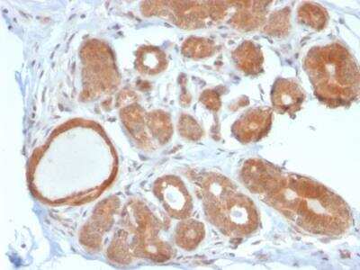 Immunohistochemistry-Paraffin: STAT5b Antibody (STAT5B/2611) - Azide and BSA Free [NBP2-79907] - Formalin-fixed, paraffin-embedded human Breast Carcinoma stained with STAT5B Mouse Monoclonal Antibody (STAT5B/2611).