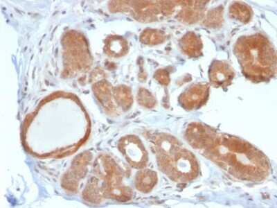 Immunohistochemistry-Paraffin: STAT5b Antibody (STAT5B/2611) [NBP2-79773] - Formalin-fixed, paraffin-embedded human Breast Carcinoma stained with STAT5b Antibody (STAT5B/2611).