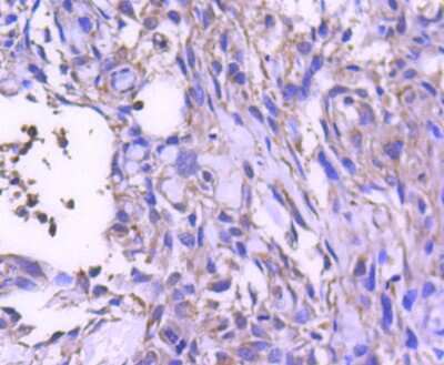 Immunohistochemistry-Paraffin: STAT6 Antibody (SY02-72) [NBP2-67445] - Analysis of paraffin-embedded human breast carcinoma tissue using anti-STAT6 antibody. Counter stained with hematoxylin.