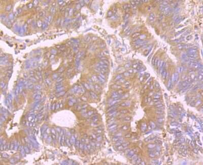 Immunohistochemistry-Paraffin: STI1 Antibody (JB95-38) [NBP2-75675] - Analysis of paraffin-embedded human colon cancer tissue using anti-STIP1 antibody. Counter stained with hematoxylin.