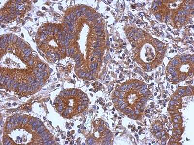 Immunohistochemistry-Paraffin: STK16 Antibody [NBP2-20514] - Immunohistochemical analysis of paraffin-embedded Colon ca, using antibody at 1:500 dilution.