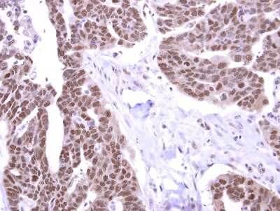 Immunohistochemistry-Paraffin: STK31 Antibody [NBP2-19305] - Stk31 antibody detects Stk31 protein at cytoplasm and nucleus on Ovarian carcinoma by immunohistochemical analysis. Sample: Paraffin-embedded Ovarian carcinoma. Stk31 antibody dilution: 1:500.