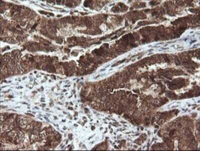 Immunohistochemistry: STK38L Antibody (OTI4D8) - Azide and BSA Free [NBP2-74403] - Analysis of Adenocarcinoma of Human ovary tissue. (Heat-induced epitope retrieval by 10mM citric buffer, pH6.0, 120C for 3min)