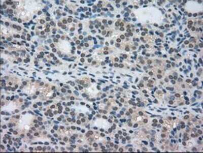 Immunohistochemistry: STK39 Antibody (OTI4E3) - Azide and BSA Free [NBP2-74406] - Staining of paraffin-embedded Carcinoma of Human thyroid tissue using anti-STK39 mouse monoclonal antibody.