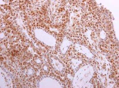 Immunohistochemistry-Paraffin: STK4 Antibody [NBP1-31233] - Human lung adenocarcinoma. STK4 antibody diluted at 1:500. Antigen Retrieval: Citrate buffer, pH 6.0, 15 min. 