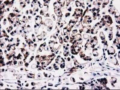 Immunohistochemistry: STRIP1 Antibody (OTI7B8) - Azide and BSA Free [NBP2-74408] - Analysis of Adenocarcinoma of Human colon tissue.