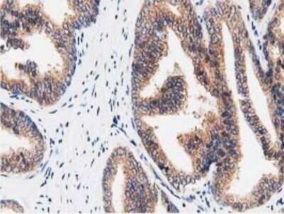 Immunohistochemistry: STRIP1 Antibody (OTI7B8) - Azide and BSA Free [NBP2-74408] - Analysis of Carcinoma of Human prostate tissue.