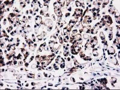 Immunohistochemistry: STRIP1 Antibody (OTI7B8) [NBP2-45715] - Analysis of Adenocarcinoma of Human colon tissue.