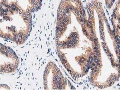 Immunohistochemistry: STRIP1 Antibody (OTI7B8) [NBP2-45715] - Analysis of Carcinoma of Human prostate tissue.