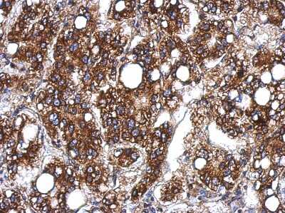 Immunohistochemistry-Paraffin: UBASH3B/STS1/Tula-2 Antibody [NBP2-20523] -  Human hepatoma, using Sts1 antibody at 1:500 dilution. Antigen Retrieval: Trilogy™ (EDTA based, pH 8.0) buffer, 15min.