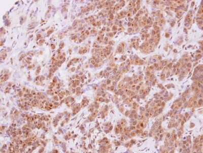 Immunohistochemistry-Paraffin: STYXL1 Antibody [NBP2-20528] - Immunohistochemical analysis of paraffin-embedded Breast ca, using antibody at 1:500 dilution.
