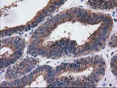 Immunohistochemistry-Paraffin: SULT1C2 Antibody (4G1) [NBP2-00486] - Staining of paraffin-embedded Adenocarcinoma of Human endometrium tissue using anti-SULT1C2 mouse monoclonal antibody.