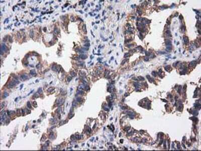 Immunohistochemistry-Paraffin: SULT1C2 Antibody (4G1) [NBP2-00486] - Staining of paraffin-embedded Carcinoma of Human lung tissue using anti-SULT1C2 mouse monoclonal antibody.