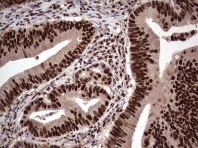 Immunohistochemistry: SUMO Activating Enzyme E1 (SAE1) Antibody (OTI6B11) - Azide and BSA Free [NBP2-74410] - Analysis of Adenocarcinoma of Human colon tissue. (Heat-induced epitope retrieval by 1 mM EDTA in 10mM Tris, pH8.5, 120C for 3min)