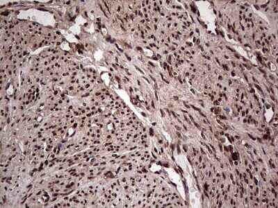 Immunohistochemistry: SUMO Activating Enzyme E1 (SAE1) Antibody (OTI6B11) - Azide and BSA Free [NBP2-74410] - Analysis of Adenocarcinoma of Human endometrium tissue. (Heat-induced epitope retrieval by 1 mM EDTA in 10mM Tris, pH8.5, 120C for 3min)