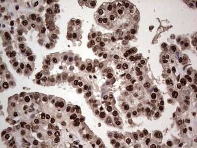 Immunohistochemistry: SUMO Activating Enzyme E1 (SAE1) Antibody (OTI6B11) - Azide and BSA Free [NBP2-74410] - Analysis of Adenocarcinoma of Human ovary tissue. (Heat-induced epitope retrieval by 1 mM EDTA in 10mM Tris, pH8.5, 120C for 3min)