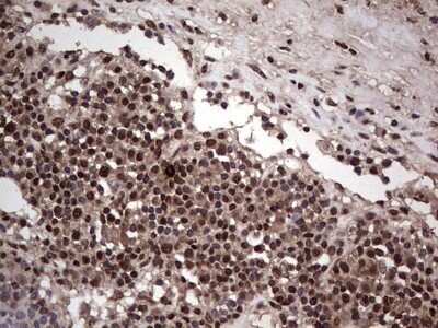 Immunohistochemistry: SUMO Activating Enzyme E1 (SAE1) Antibody (OTI6B11) - Azide and BSA Free [NBP2-74410] - Analysis of Carcinoma of Human bladder tissue. (Heat-induced epitope retrieval by 1 mM EDTA in 10mM Tris, pH8.5, 120C for 3min)