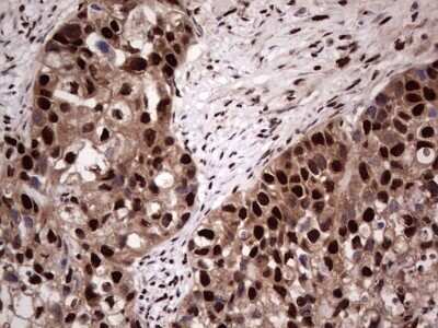 Immunohistochemistry: SUMO Activating Enzyme E1 (SAE1) Antibody (OTI6B11) - Azide and BSA Free [NBP2-74410] - Analysis of Carcinoma of Human kidney tissue. (Heat-induced epitope retrieval by 1 mM EDTA in 10mM Tris, pH8.5, 120C for 3min)