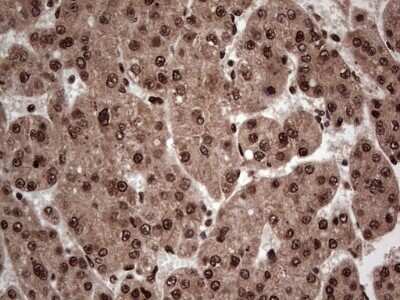 Immunohistochemistry: SUMO Activating Enzyme E1 (SAE1) Antibody (OTI6B11) - Azide and BSA Free [NBP2-74410] - Analysis of Carcinoma of Human liver tissue.(Heat-induced epitope retrieval by 1 mM EDTA in 10mM Tris, pH8.5, 120C for 3min)