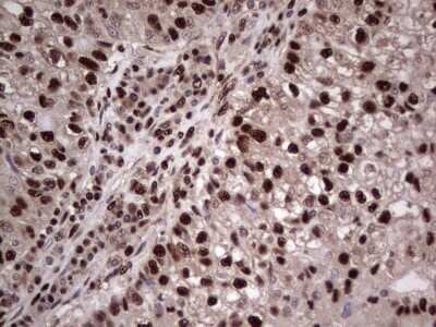 Immunohistochemistry: SUMO Activating Enzyme E1 (SAE1) Antibody (OTI6B11) - Azide and BSA Free [NBP2-74410] - Analysis of Carcinoma of Human lung tissue.(Heat-induced epitope retrieval by 1 mM EDTA in 10mM Tris, pH8.5, 120C for 3min)