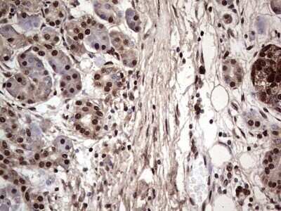 Immunohistochemistry: SUMO Activating Enzyme E1 (SAE1) Antibody (OTI6B11) - Azide and BSA Free [NBP2-74410] - Analysis of Carcinoma of Human pancreas tissue. (Heat-induced epitope retrieval by 1 mM EDTA in 10mM Tris, pH8.5, 120C for 3min)