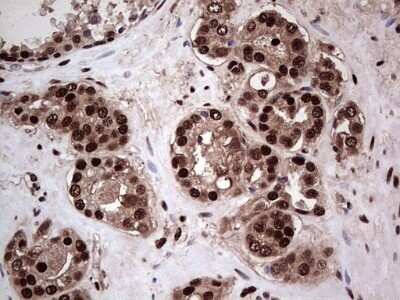 Immunohistochemistry: SUMO Activating Enzyme E1 (SAE1) Antibody (OTI6B11) - Azide and BSA Free [NBP2-74410] - Analysis of Carcinoma of Human prostate tissue. (Heat-induced epitope retrieval by 1 mM EDTA in 10mM Tris, pH8.5, 120C for 3min)