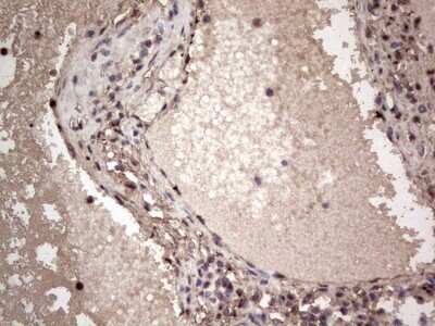 Immunohistochemistry: SUMO Activating Enzyme E1 (SAE1) Antibody (OTI6B11) - Azide and BSA Free [NBP2-74410] - Analysis of Carcinoma of Human thyroid tissue. (Heat-induced epitope retrieval by 1 mM EDTA in 10mM Tris, pH8.5, 120C for 3min)