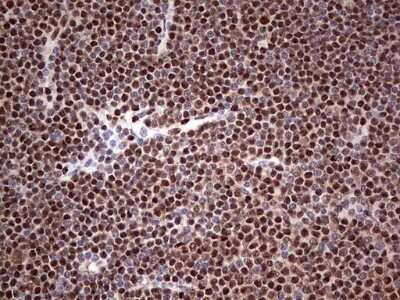 Immunohistochemistry: SUMO Activating Enzyme E1 (SAE1) Antibody (OTI6B11) - Azide and BSA Free [NBP2-74410] - Analysis of Human lymphoma tissue. (Heat-induced epitope retrieval by 1 mM EDTA in 10mM Tris, pH8.5, 120C for 3min)