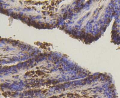 Immunohistochemistry-Paraffin: SUMO1 Antibody (SJ20-03) [NBP2-67419] - Analysis of paraffin-embedded human breast carcinoma tissue using anti-SUMO-1 antibody. Counter stained with hematoxylin.