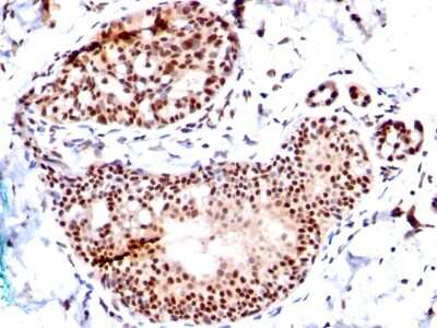 Immunohistochemistry-Paraffin: SUMO1 Antibody (SM1/495) - Azide and BSA Free [NBP2-34716] - Formalin-paraffin human Breast Ca