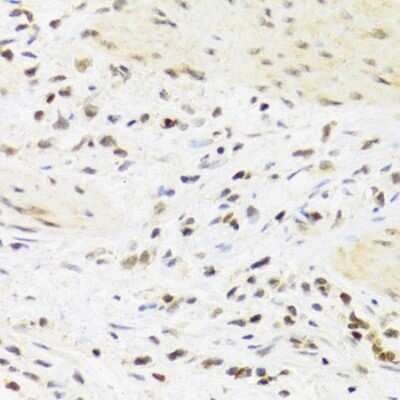 Immunohistochemistry-Paraffin: SUMO4 Antibody [NBP2-95198] - Paraffin-embedded human breast cancer using SUMO4 .