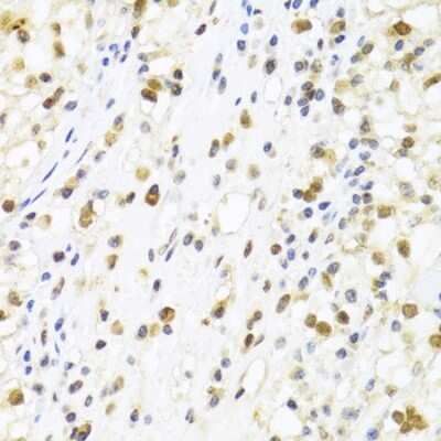 Immunohistochemistry-Paraffin: SUMO4 Antibody [NBP2-95198] - Paraffin-embedded human kidney cancer using SUMO4 .