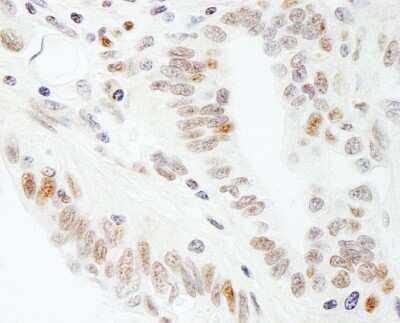 Immunohistochemistry-Paraffin: SUPT5H Antibody [NB110-40593] - Section of human ovarian carcinoma. Antibody: Affinity purified rabbit anti- SUPT5H used at a dilution of 1:1,000 (1ug/ml). Detection: DAB